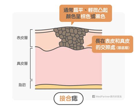 點痣 流血|點痣筆一擦，黑痣就掉了？醫師冷笑科科兩聲：「點痣。